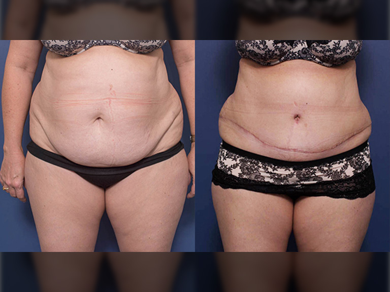 Tummy tuck before and after 11A, Dr Peters Brisbane