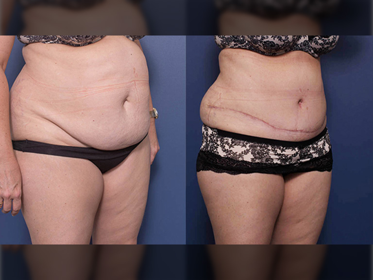 Tummy tuck B&A 11B, Dr Peters