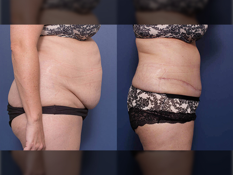 Tummy tuck before and after 11C, Dr Peters