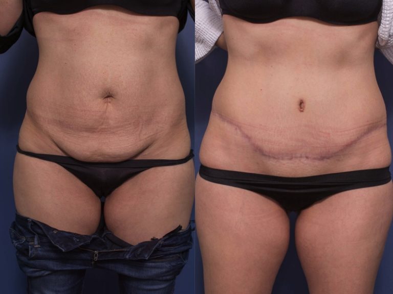 Tummy tuck patient 12A, Dr Peters