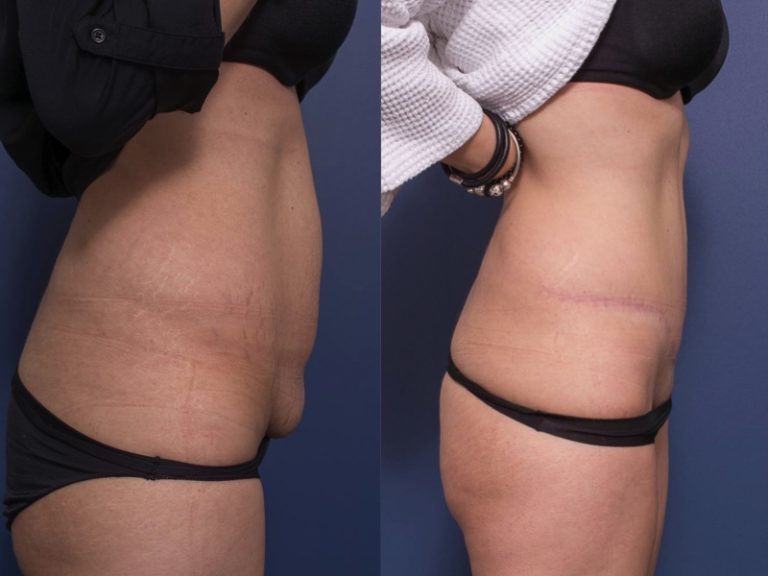 Before & after gallery, tummy tuck photo 12B, Dr Peters