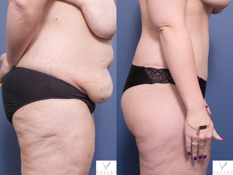 Tummy Tuck patient before & after 1C, Dr Peters
