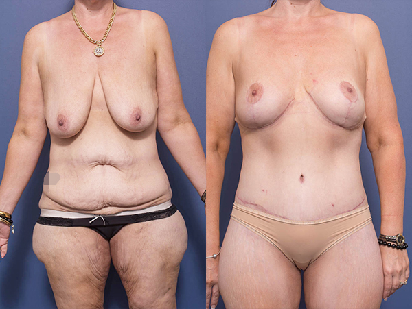 Total Body Lift (Thigh Reduction included) before and after 1A
