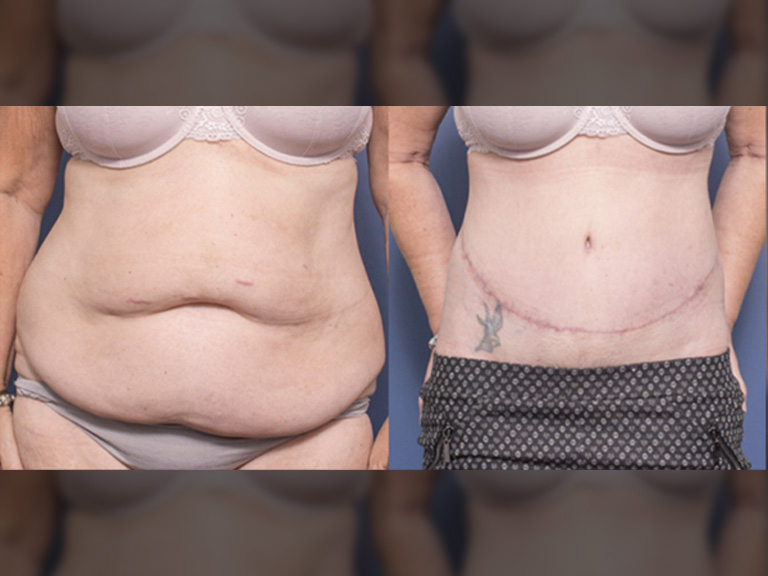 Tummy tuck before and after 3A, Dr Peters