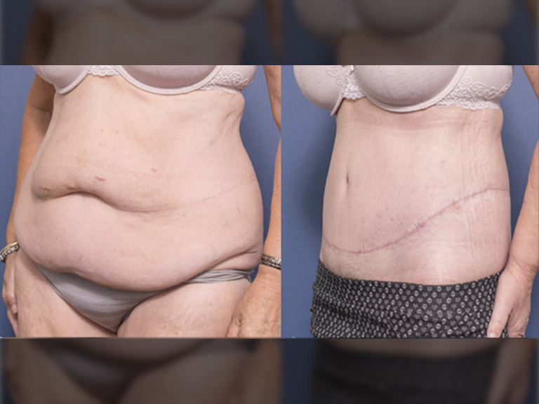 Dr Peters patient before and after tummy tuck 3B, side view