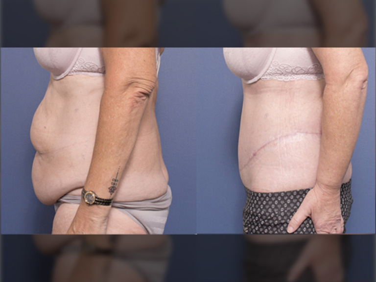 Tummy tuck results with Dr Peters 3C