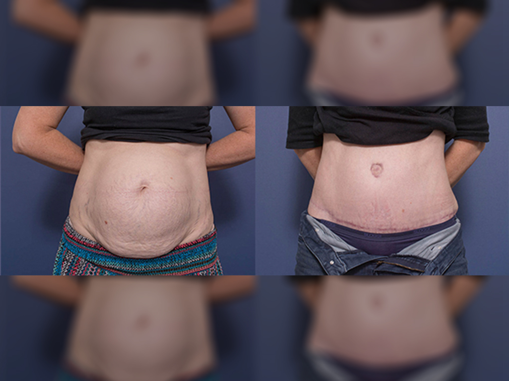 Tummy tuck before and after 4A, front view, Dr Peters