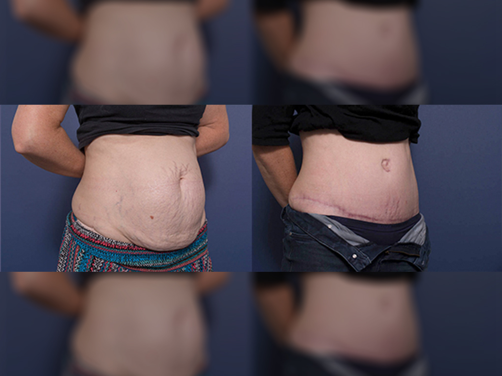 Tummy Tuck surgery with Dr Peters, before and after photo 4B