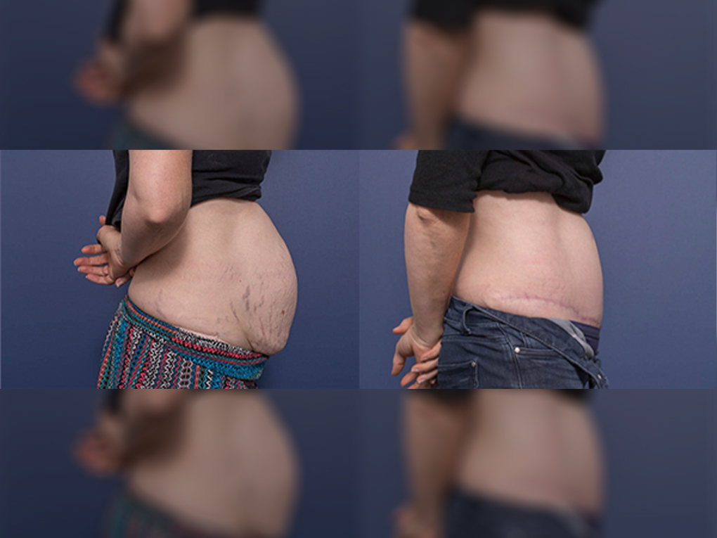 Abdominoplasty before & after 4C