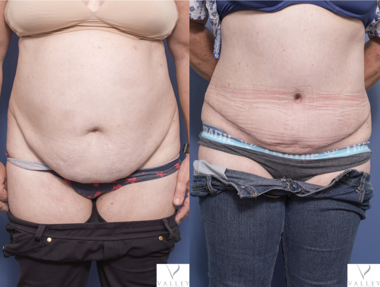 Patient 6A before & after tummy tuck with Dr Peters in Brisbane