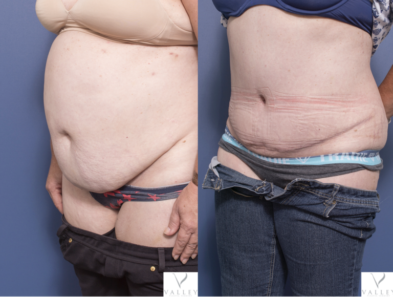 Tummy tuck before & after 6B, Dr Peters