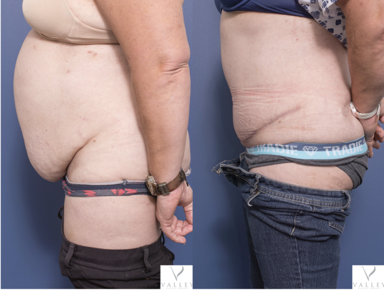 Abdominoplasty patient before & after 6C, Dr Peters Brisbane