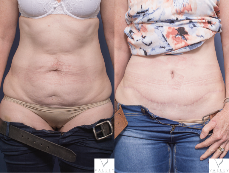 Dr Peters Abdominoplasty patient 7A, front view