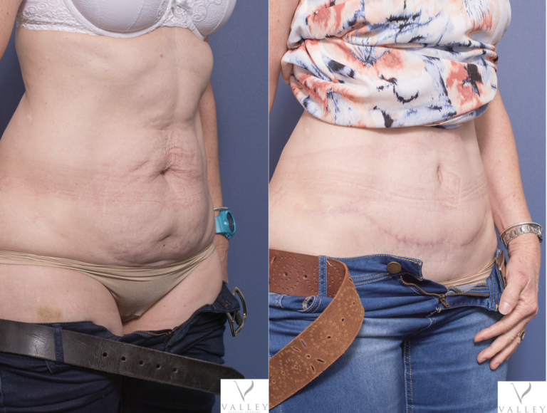 Before and after tummy tuck 7B, Dr Peters