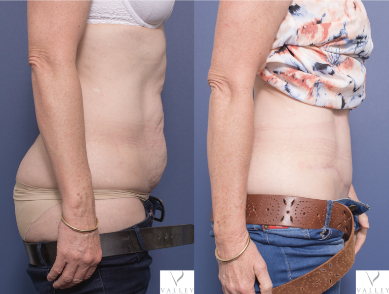 Tummy Tuck gallery, before & after 7C