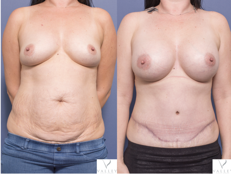 Breast Augmentation and Abdominoplasty 8A, Before & after gallery, Dr Peters