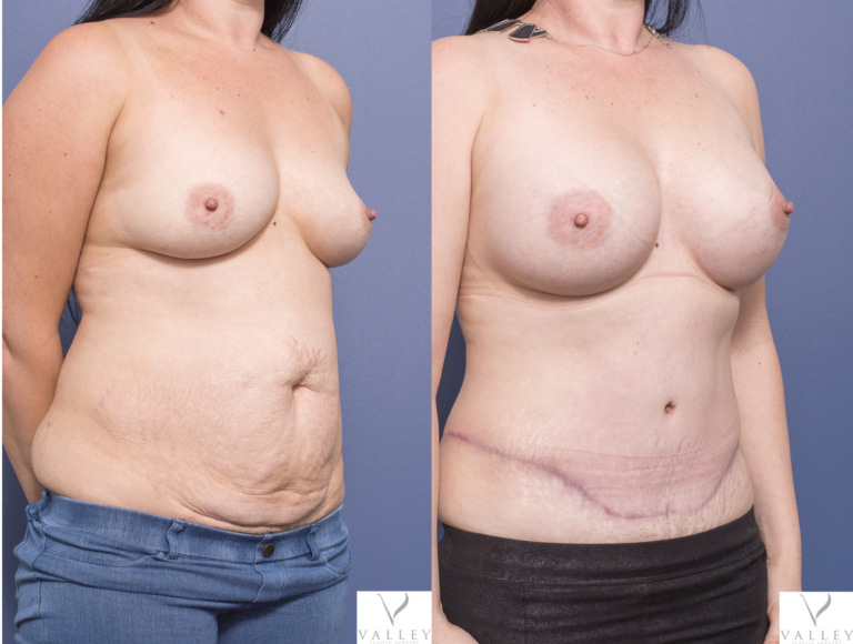 Patient 8B before & after tummy tuck & breast augmentation, Dr Peters