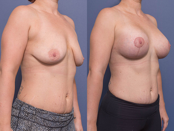 Breast Augmentation Mastopexy 10B