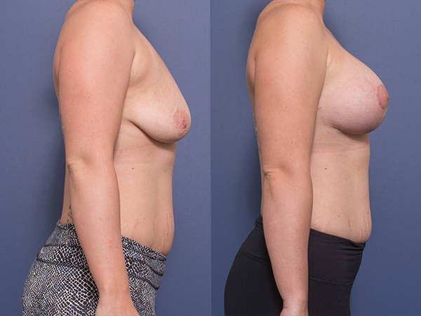 Breast Implants with Lift before & after 10C