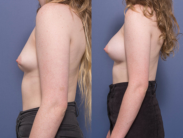 Breast Augmentation (Dual Plane) before & after 13C