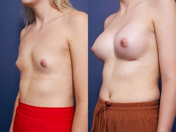 Breast augmentation and Lift, before & after gallery 14B, Dr Peters