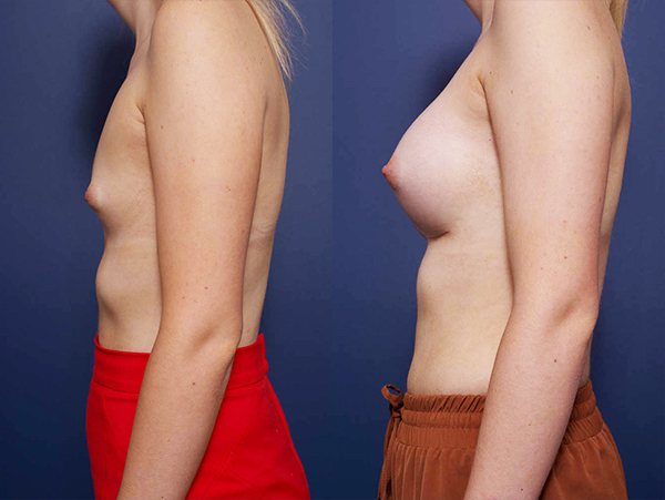 Before and after breast augmentation with Dr Peters 14C, side view