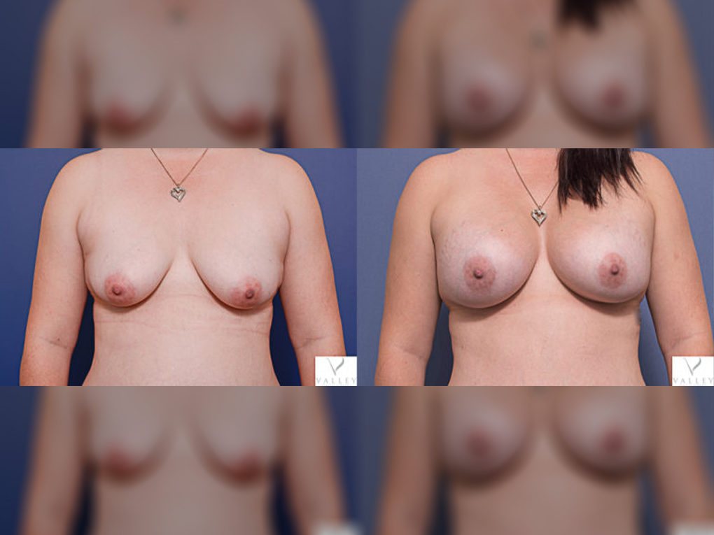 Breast Augmentation with Mentor Implants 15A
