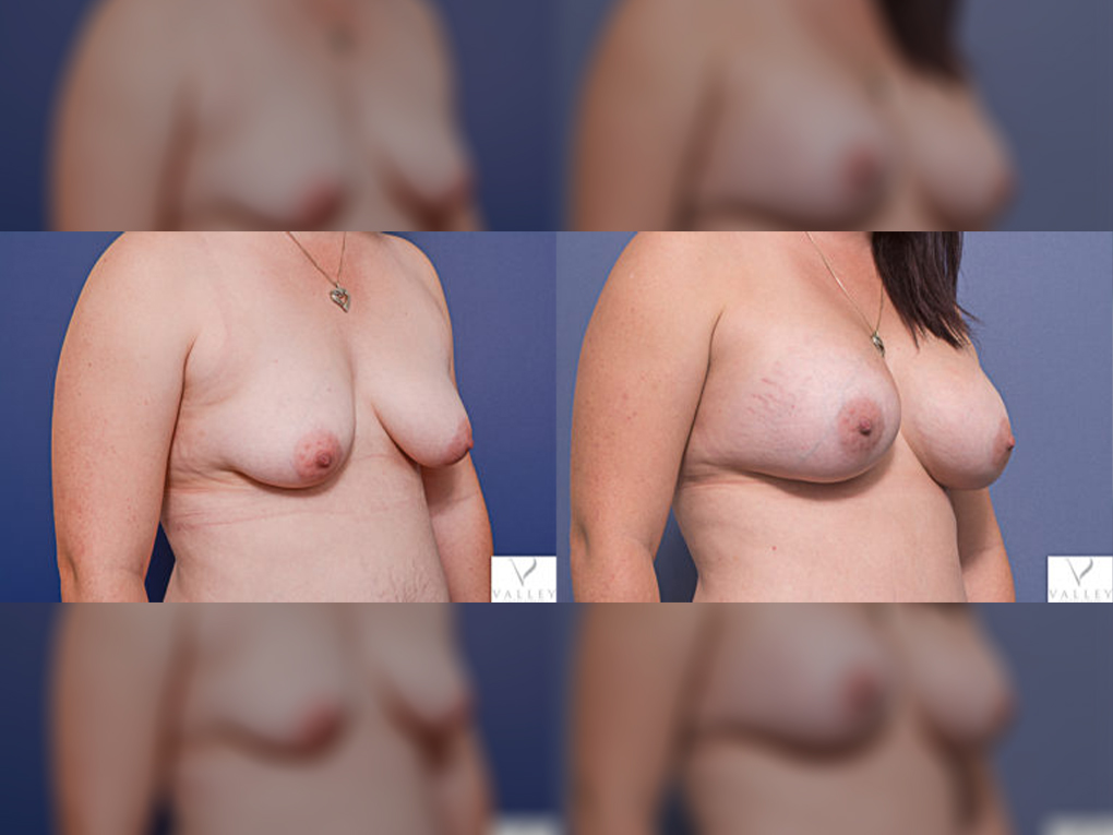 Breast implants surgery (475cc and 555cc), Dr Peters Brisbane