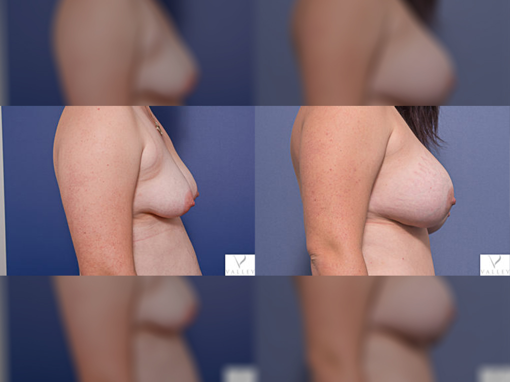 Boob Job, Dual Plane Placement (475cc & 555cc), before and after 15C