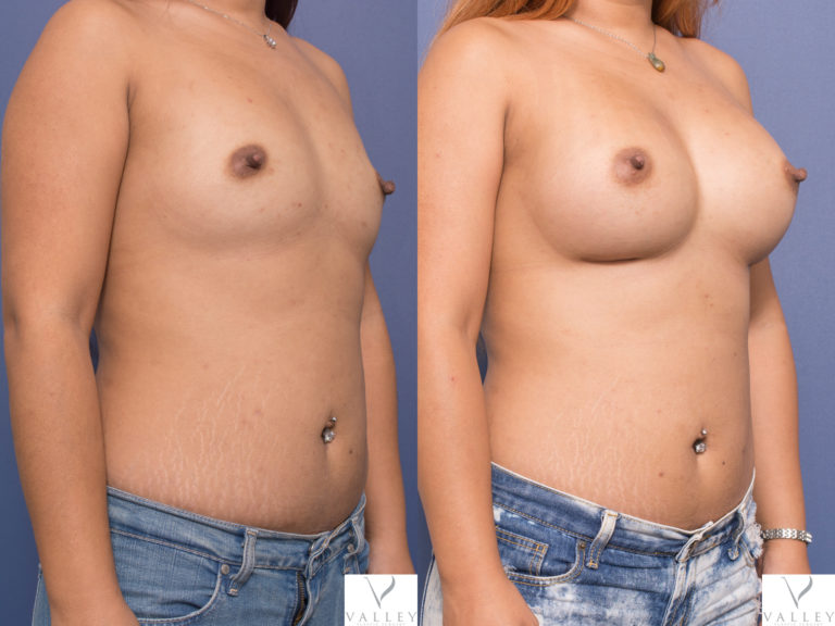 Boob job surgery with Dr Peters, patients gallery 17B