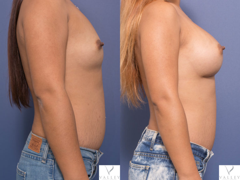 Dr Peters, Breast Implants 390cc, Mentor Implants
