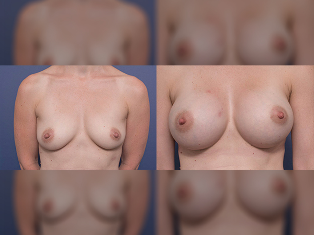 Breast Augmentation before & after 2A (400cc round implants), Dr Peters
