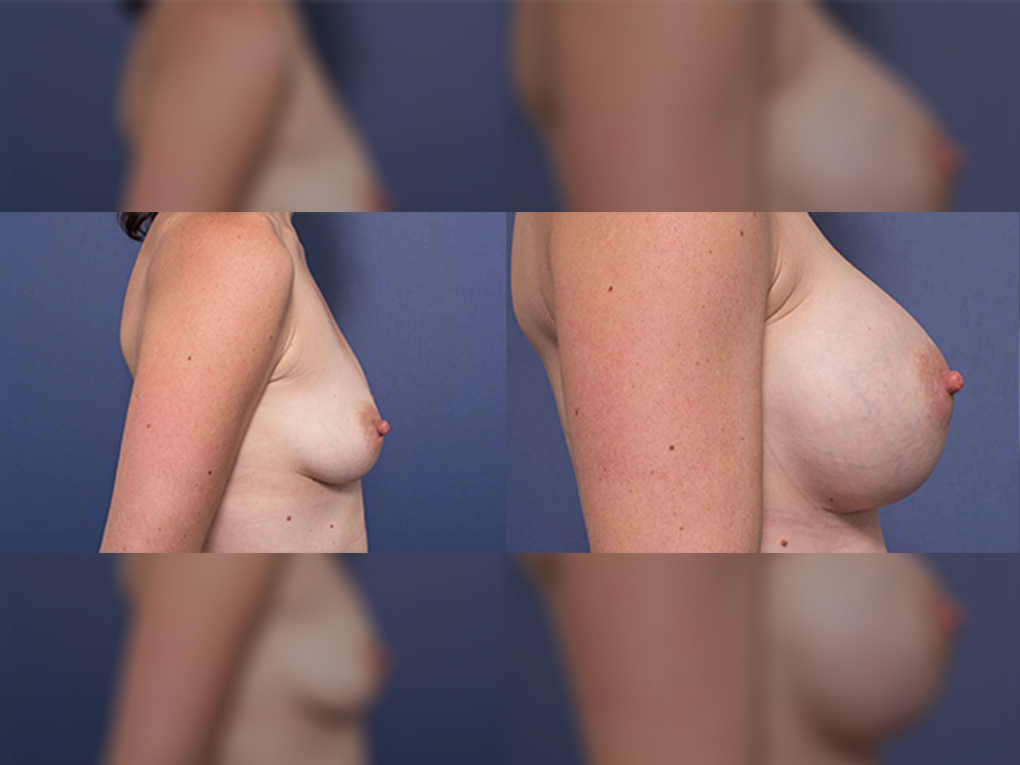Breast Implants surgery before and after 2C, Dr Peters Brisbane, side view