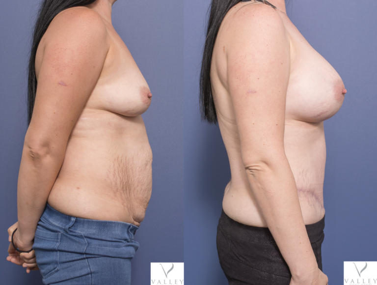 Breast Implants surgery (and Abdominoplasty) before & after 3C, Dr Matthew Peters