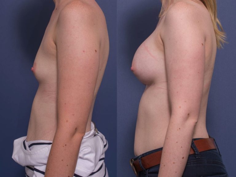 Boob Job (300cc) before & after, photo 4C, Dr Peters