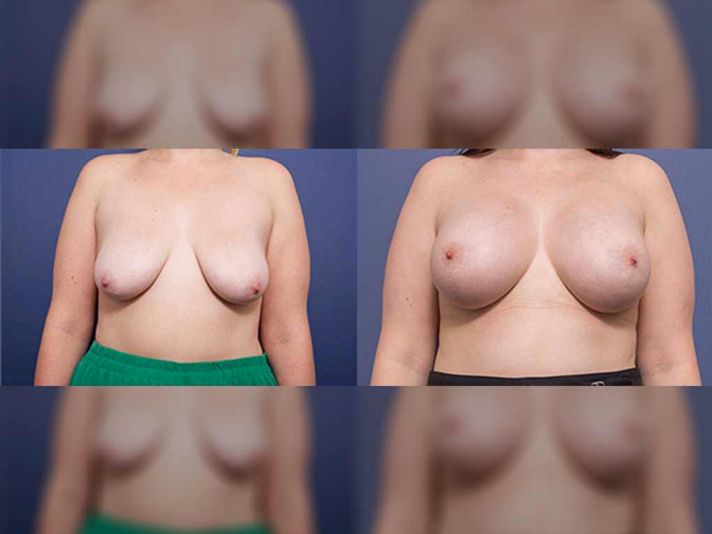 Breast Implants and Lift before & after 6A, front view