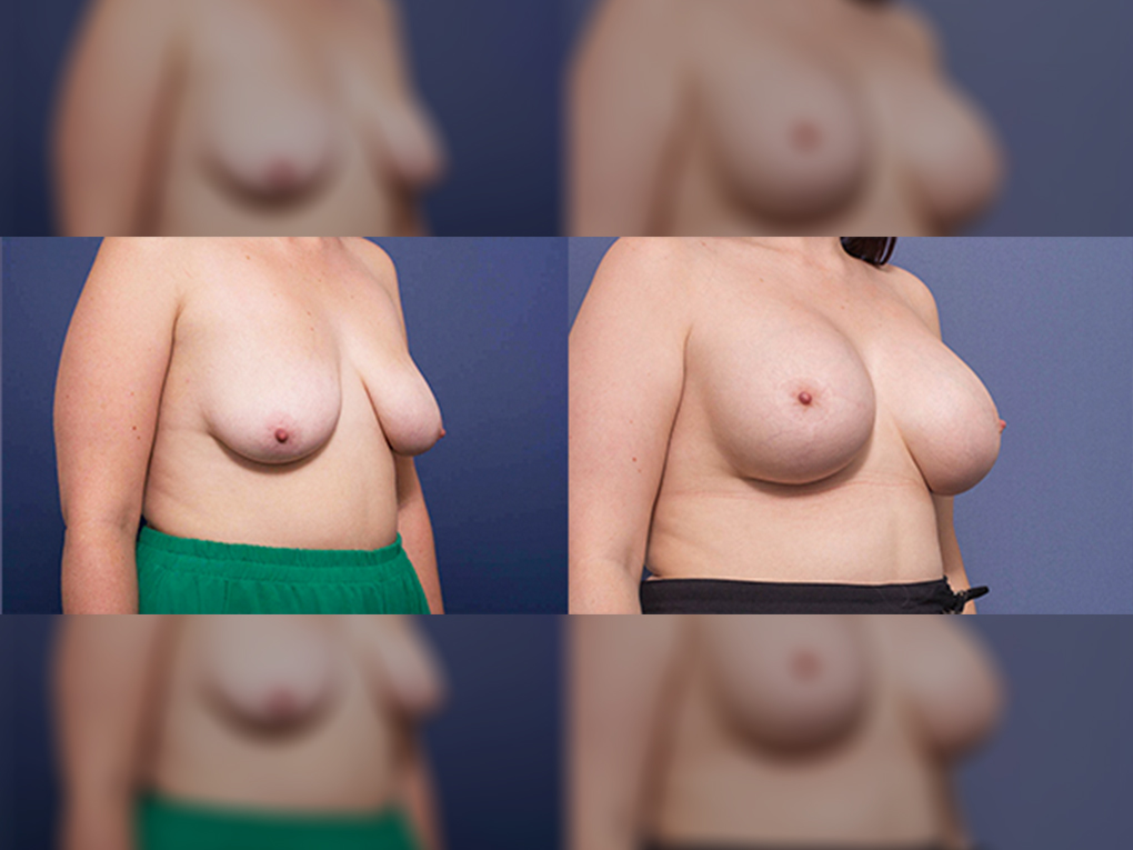 Breast augmentation with implants 400cc, before & after gallery 6B