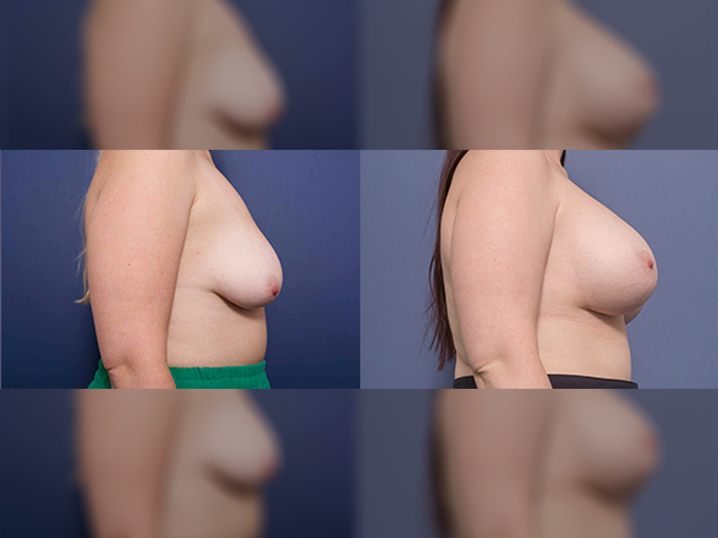 Breast Augmentation and Lift 6C, Dr Peters