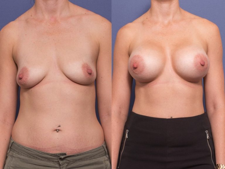 Breast Implants surgery before and after 7A (440cc), Dr Peters Brisbane