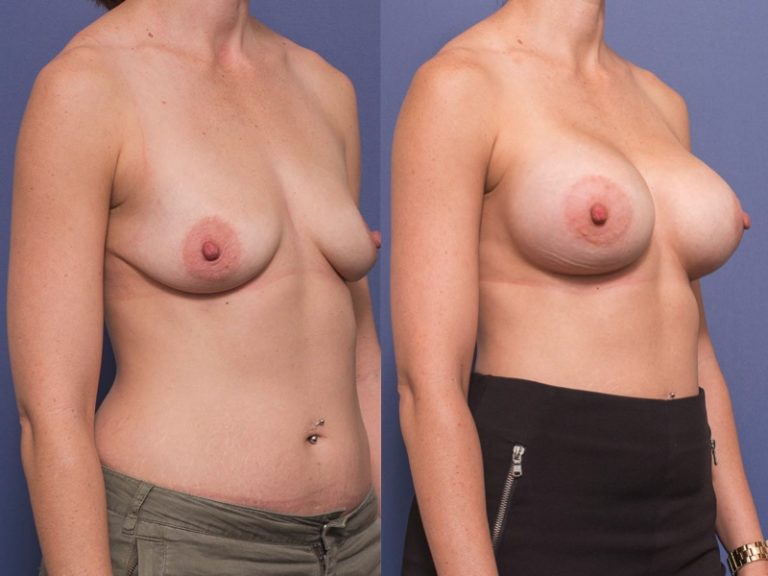 Breast Augmentation with anatomical implants (440 cc), before & after 7B