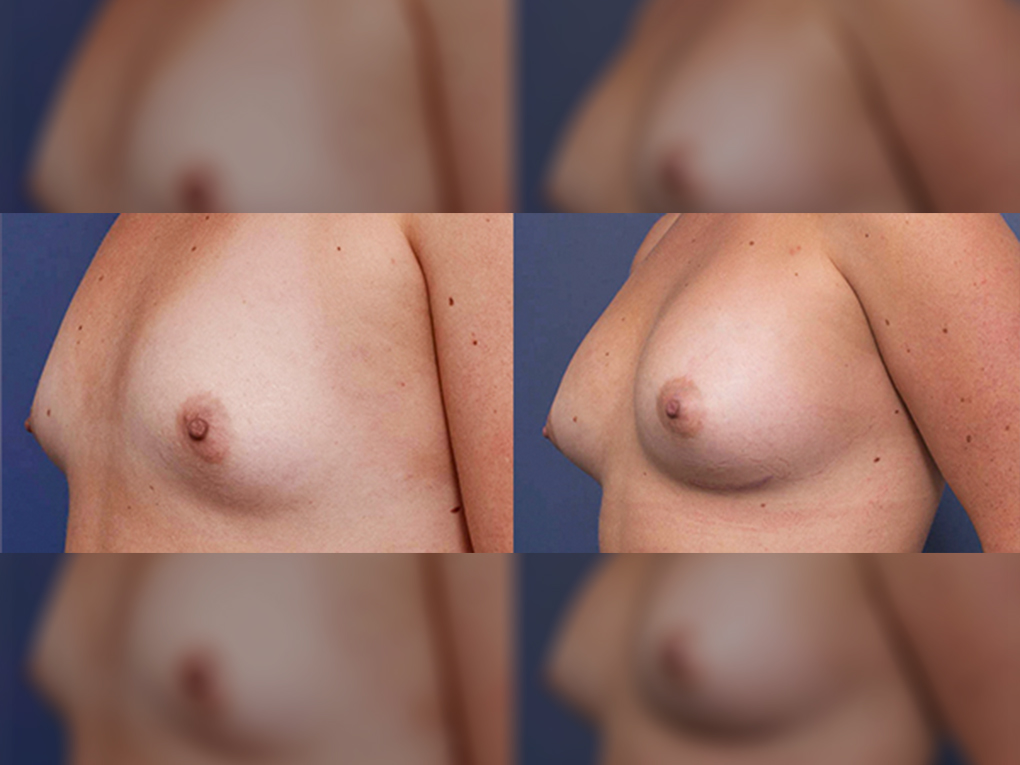 Anatomical implants 330cc, Boob job before and after 9B