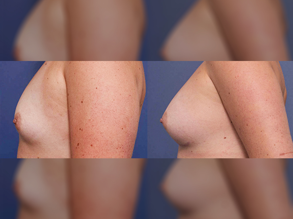 Breast implants surgery before & after 9C, Dr Peters, side view