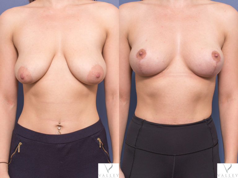 Breast Lift Surgery before & after 1A, Dr Peters Brisbane QLD