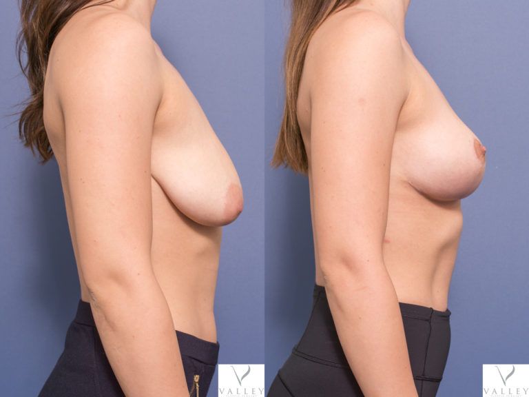 Patient before and after Breast Lift at Dr Peters clinic in Brisbane, photo 1C