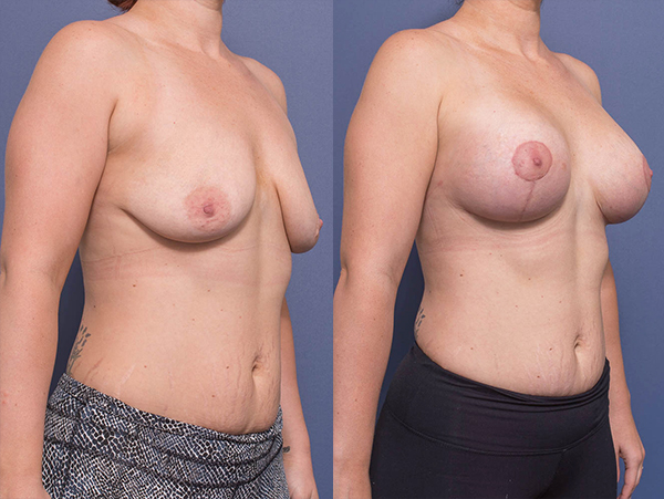 Breast Lift and Implants (Round 400cc) before and after 2B, Dr Peters