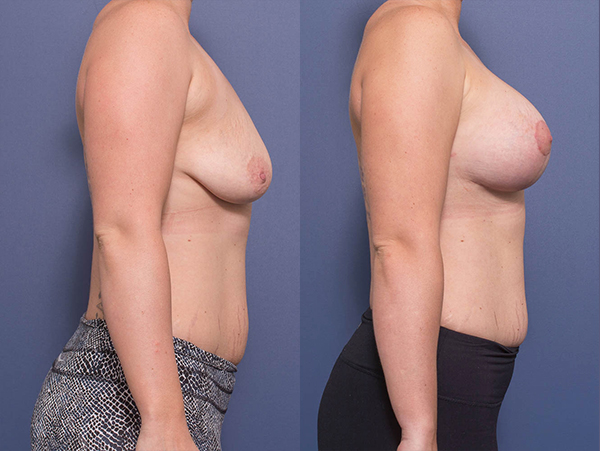 Breast Lift and Implants (400 cc), before and after gallery 2C