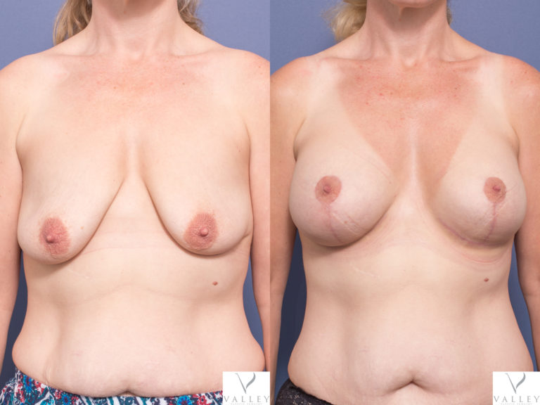 Breast surgery before and after 3A, Breast Augmentation Mastopexy, Dr Peters Brisbane