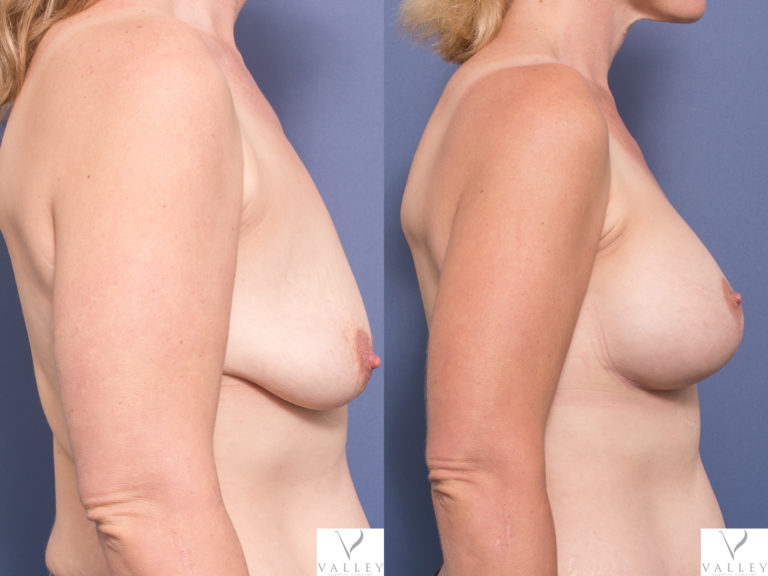 Breast Lift and Breast Augmentation before and after 3C, Dr Peters