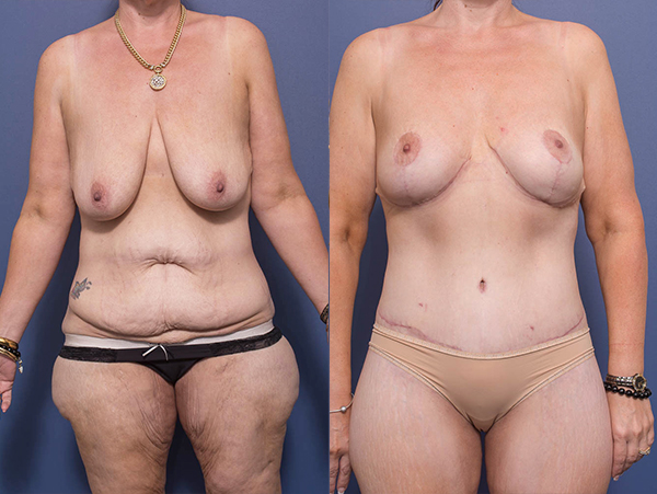 Breast Lift before and after gallery 4A, Dr Peters Brisbane QLD