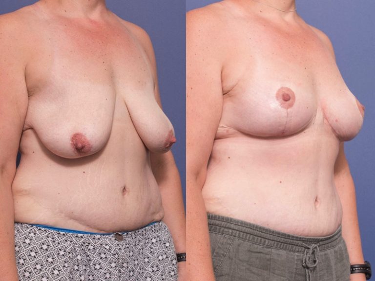 Breast Lift surgery at Dr Peters Brisbane clinic, patient's photo 6B